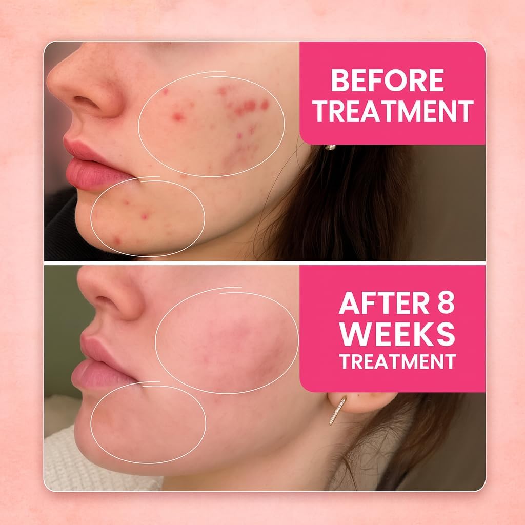 Thermolab Aura Pro LED Face Mask